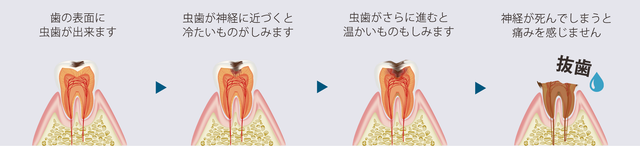 むし歯の進行