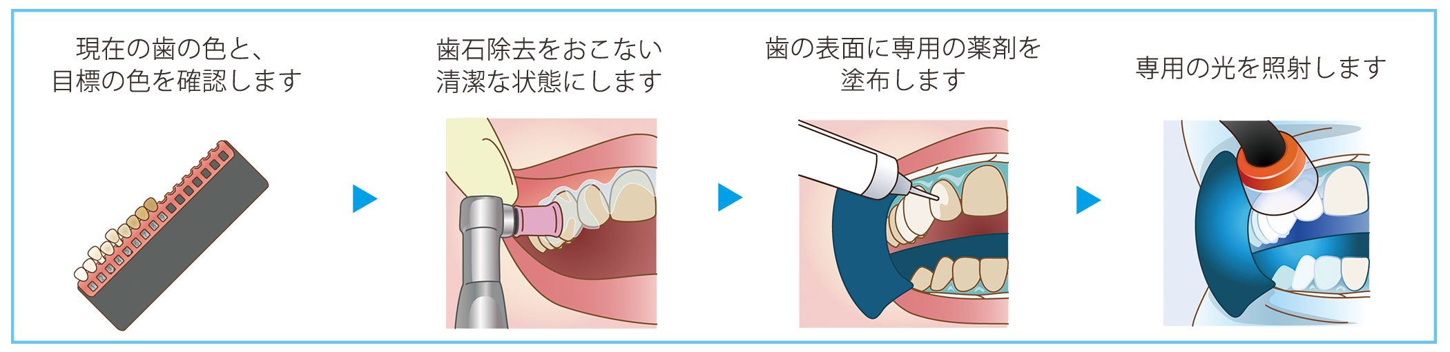 オフィスホワイトニングの流れ