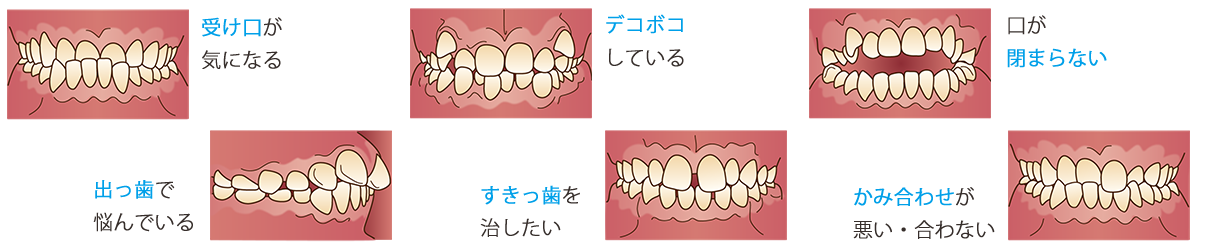 色々な種類の歯並び