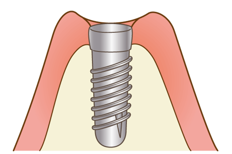 インプラント埋入手術（一次オペ）