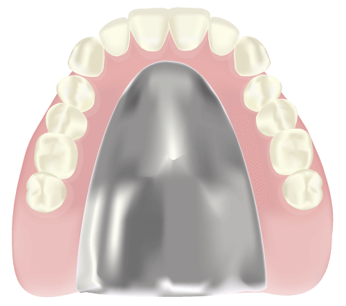 金属床義歯