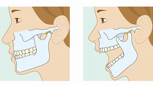 顎関節症